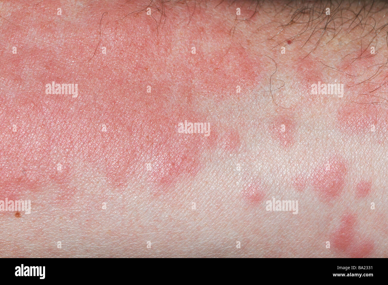 Close up di rash sul braccio dal portoghese di uomo o' guerra (Physalia physalis), noto anche come la bolla blu, blu bottiglia, uomo di guerra Foto Stock