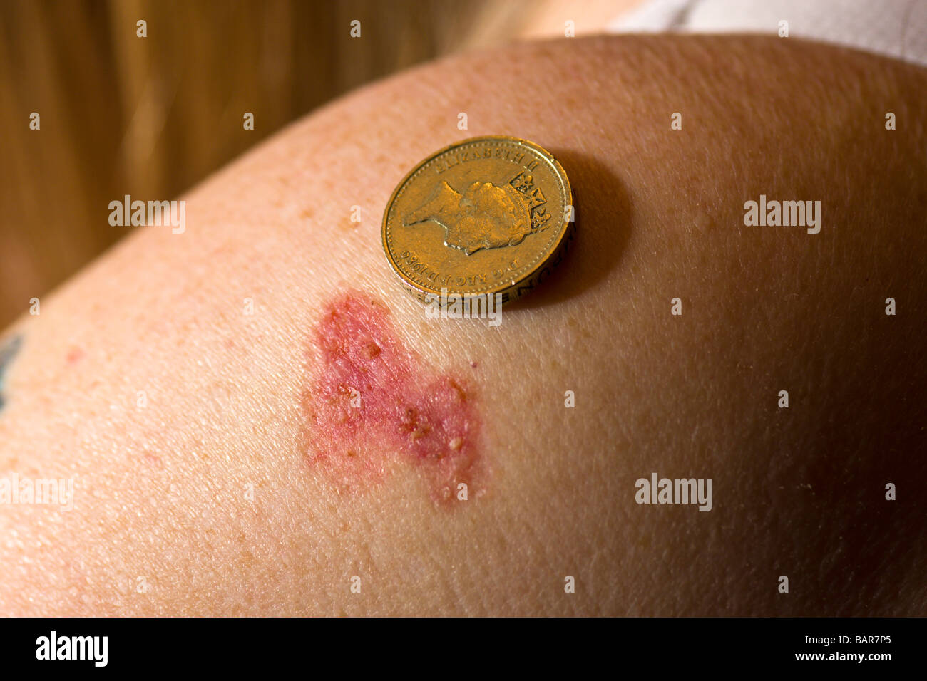 Il Carcinoma a cellule basali Foto Stock