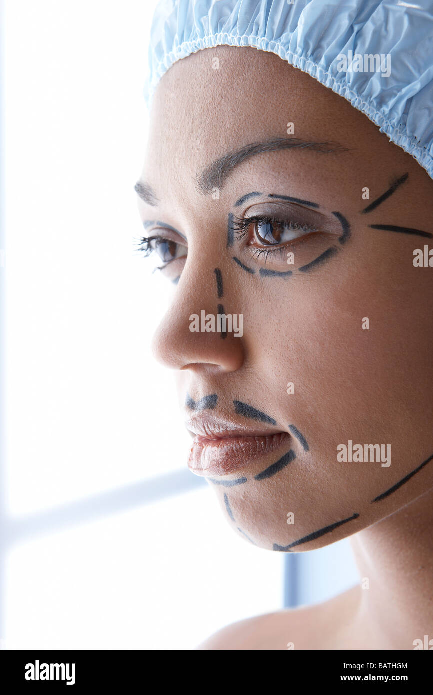 Lifting facciale. Linee guida per le incisioni chirurgiche su una faccia del paziente. Foto Stock