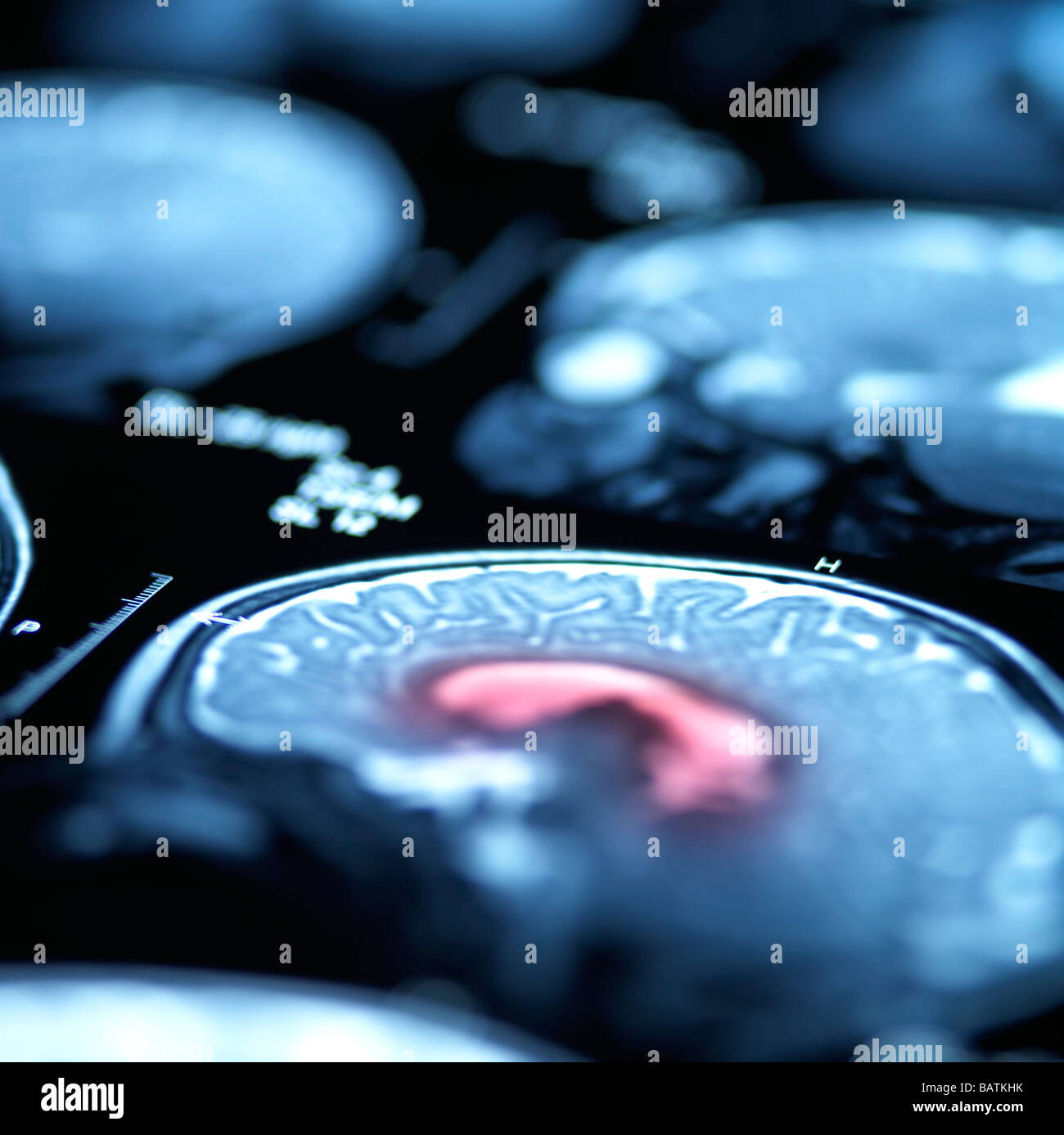 Scansioni cerebrali. Sagittale (lateralmente) scansione attraversoil testa, rivelando la struttura del cervello. Foto Stock