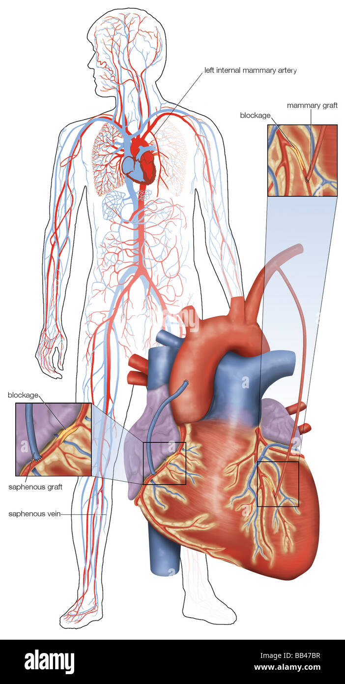 Schema della doppia chirurgia di bypass delle arterie coronariche. Foto Stock