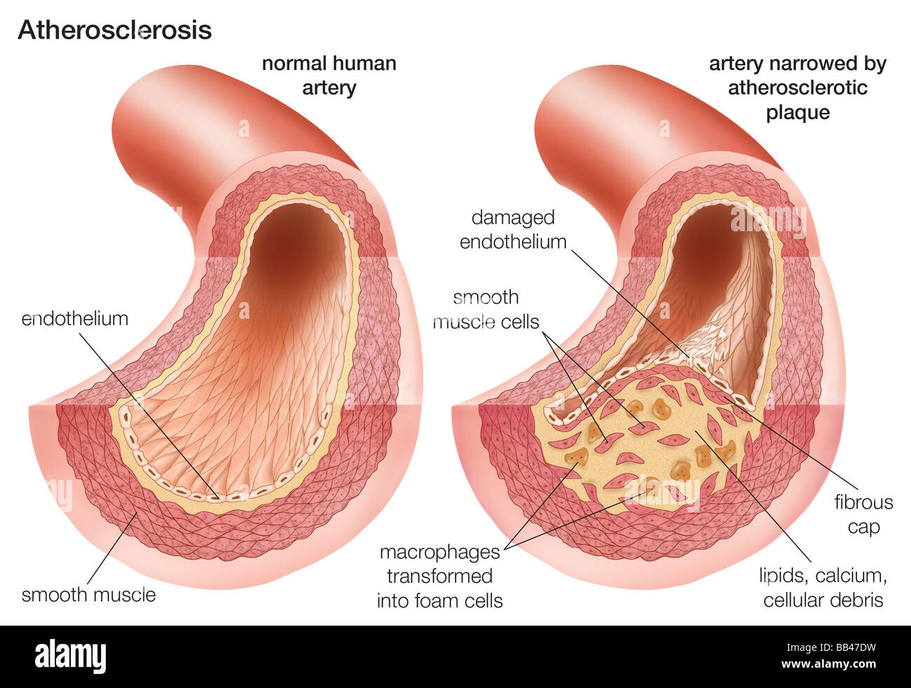 Aterosclerosi: confronto di una arteria normale con una arteria ristretta di placca aterosclerotica Foto Stock