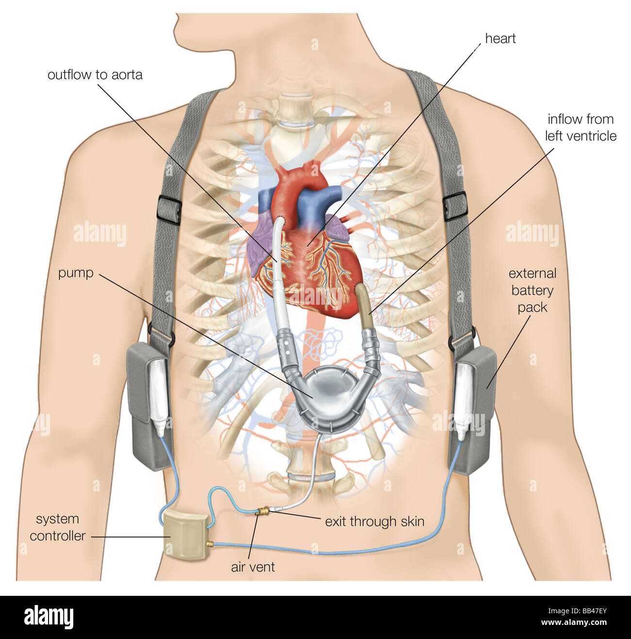 Ventricular Assist Device, un cuore artificiale che aiuta la pompa sangue ossigenato attraverso l'aorta e ai tessuti dell'organismo. Foto Stock