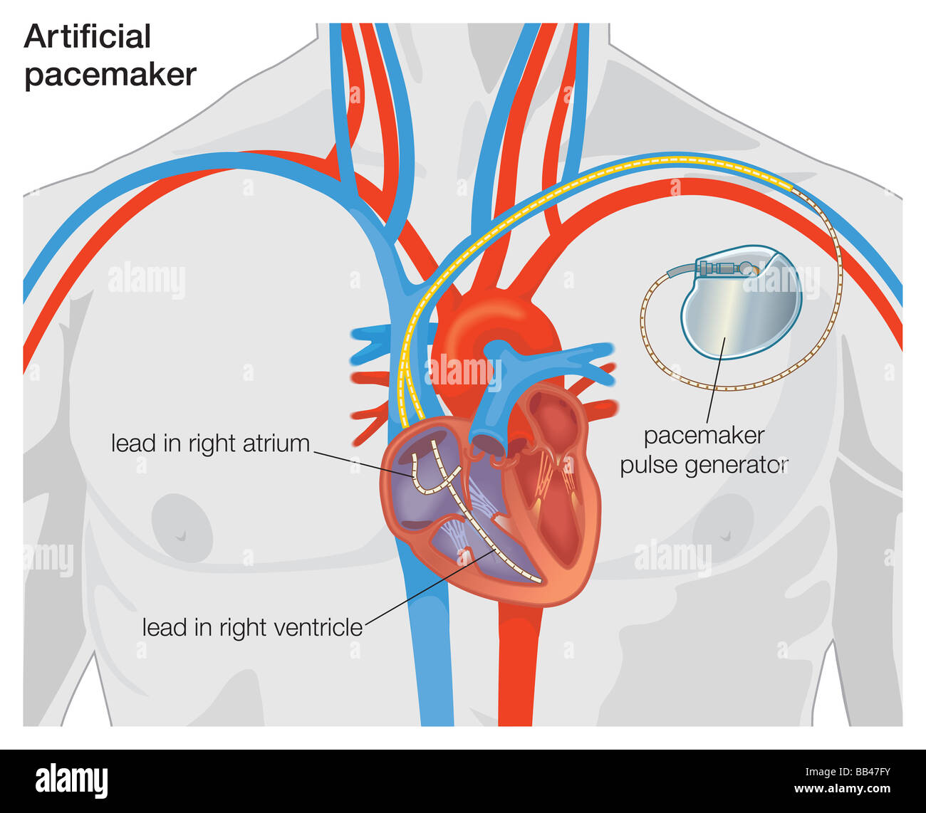 Schema di un pacemaker artificiale Foto Stock