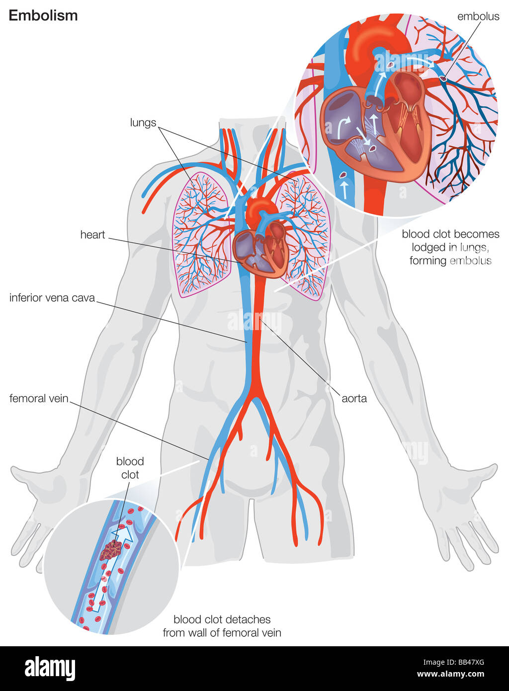 Schema dimostrativo per la progressione di un'embolia arteriosa Foto Stock