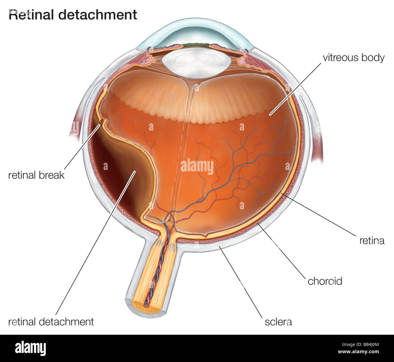 Schema di un distacco della retina. Foto Stock