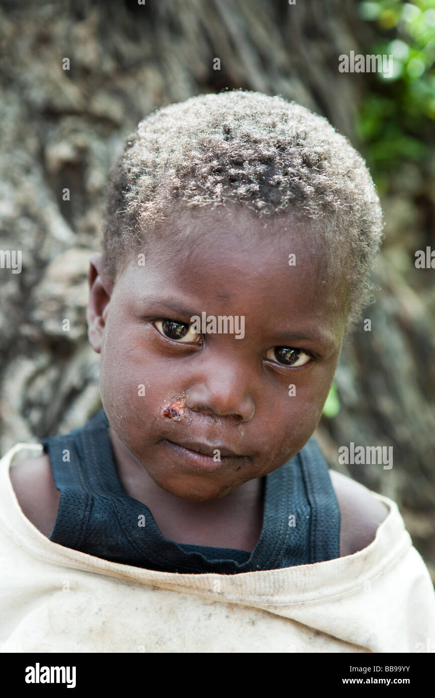 Ragazzo con una ferita aperta sul suo volto nel villaggio di Nyombe, Malawi, Africa Foto Stock