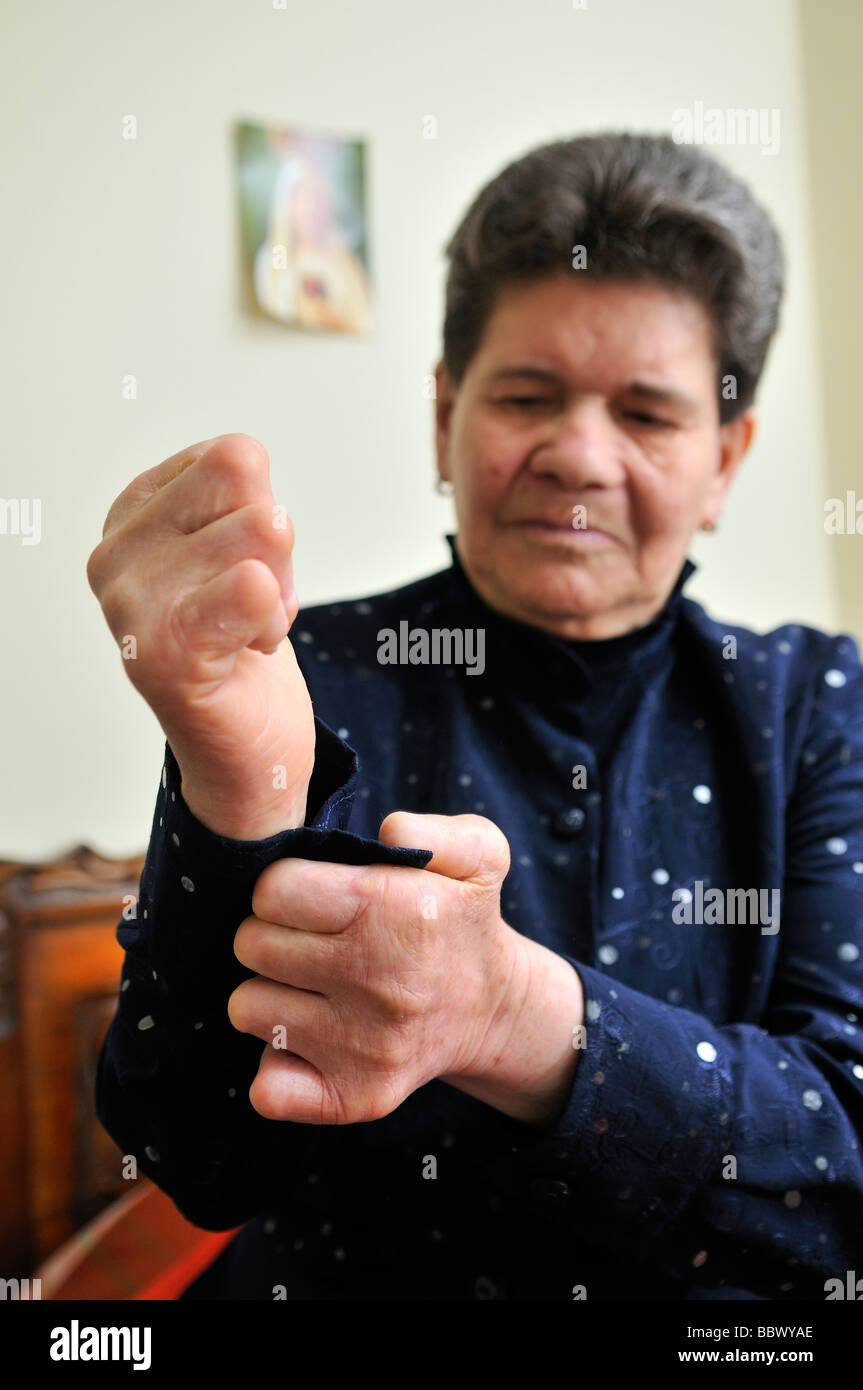 La lebbra paziente, 72 anni, con storpi mani, chiude la sua camicetta del pulsante, Bogotà, Colombia, Sud America Foto Stock