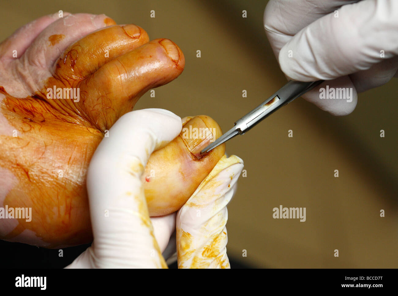 Podiatrist eseguendo la resezione a cuneo chirurgia su un incarniti toenail l area è stata tamponata con soluzione antisettica Foto Stock