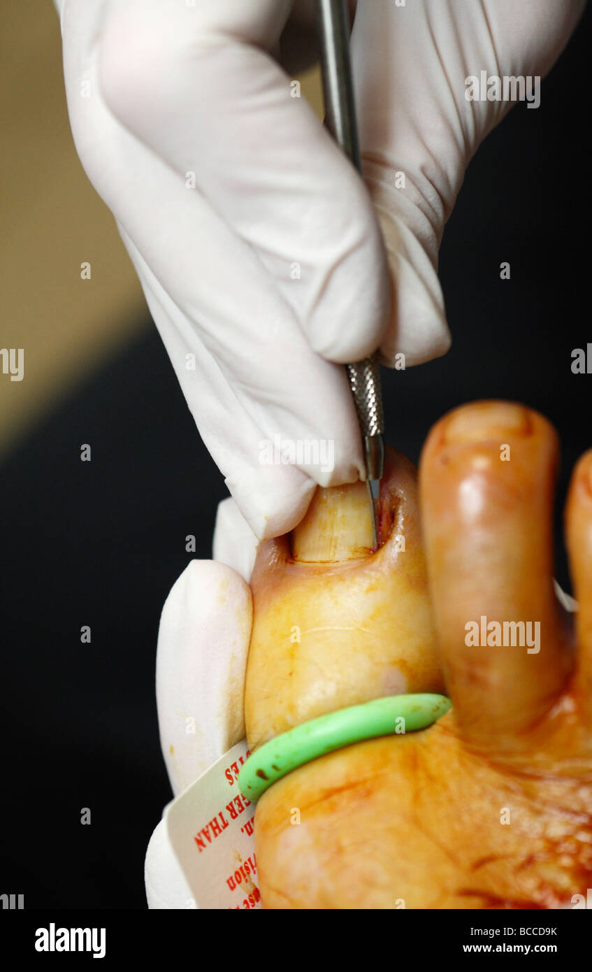 La resezione a cuneo chirurgia su un incarniti toenail l area è stata tamponata con soluzione antisettica e un tourniquet applicato Foto Stock