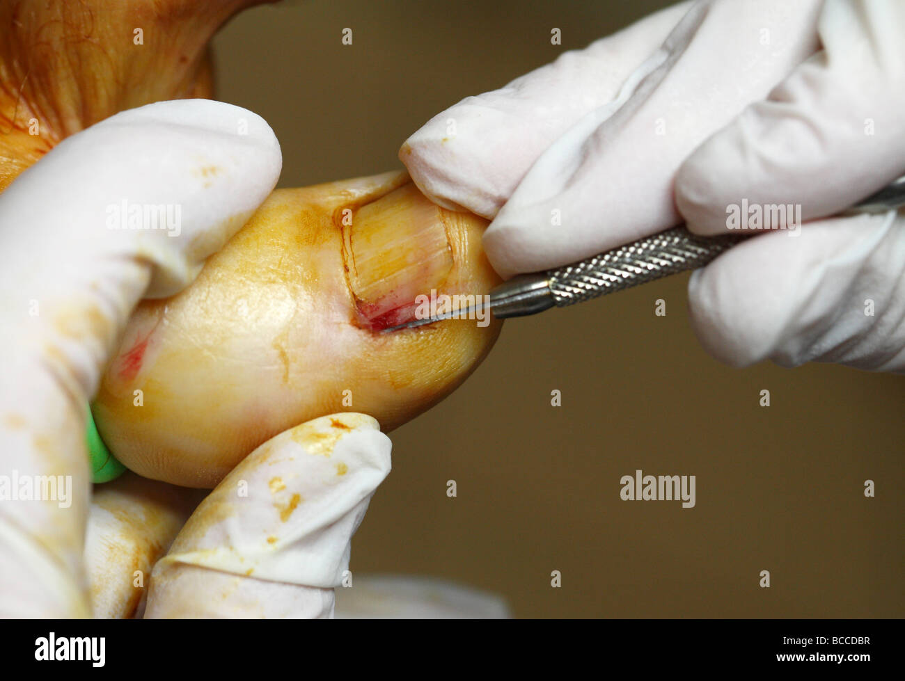 Podiatrist eseguendo la resezione a cuneo chirurgia su un incarniti toenail l area è stata tamponata con soluzione antisettica Foto Stock