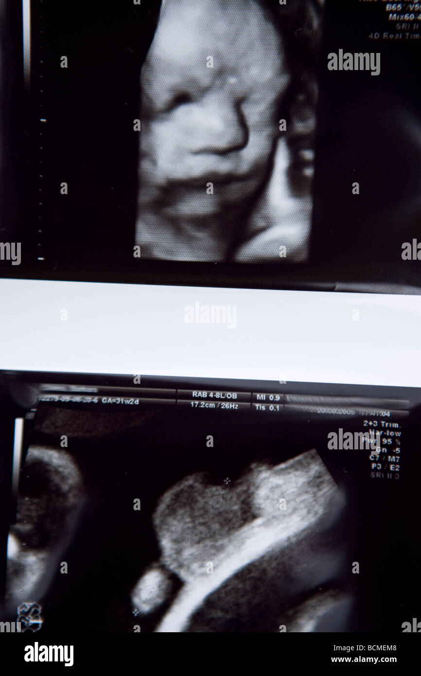 Ecografia di un feto embrione boy Foto Stock