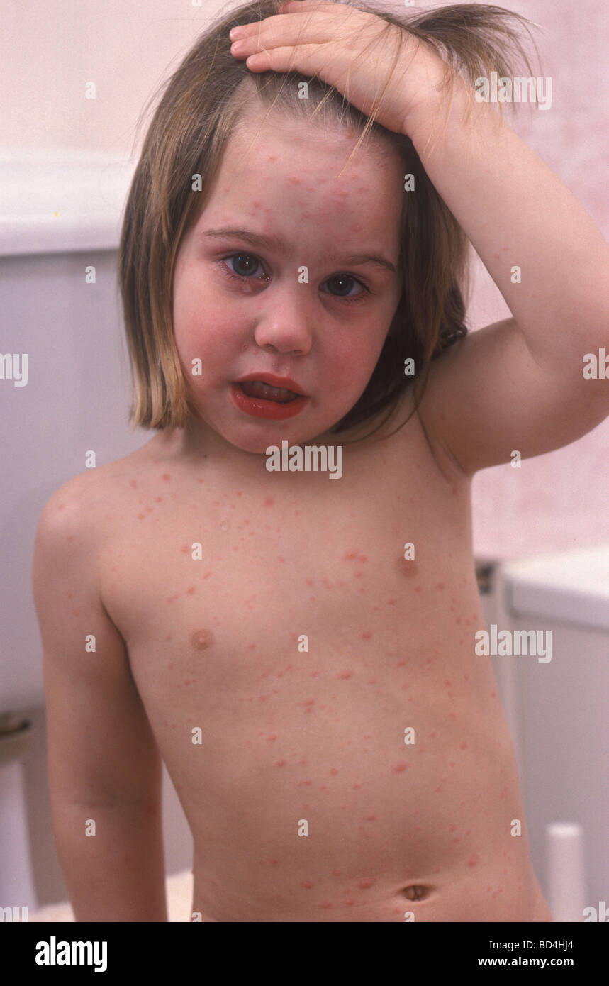 Bambina con la varicella cercando teary Foto Stock