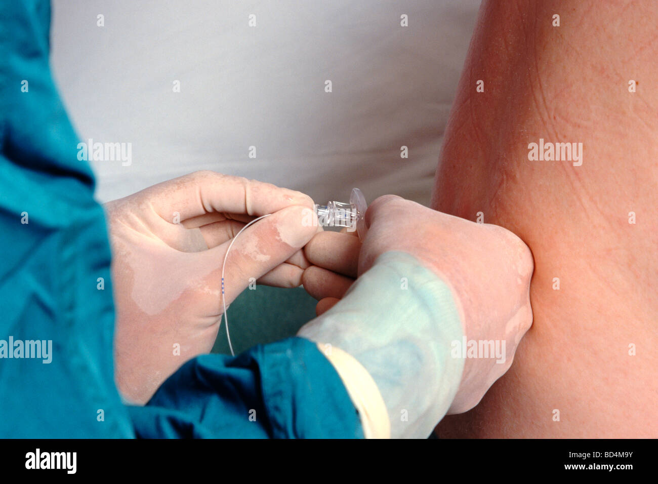 Epidurale immagini e fotografie stock ad alta risoluzione - Alamy