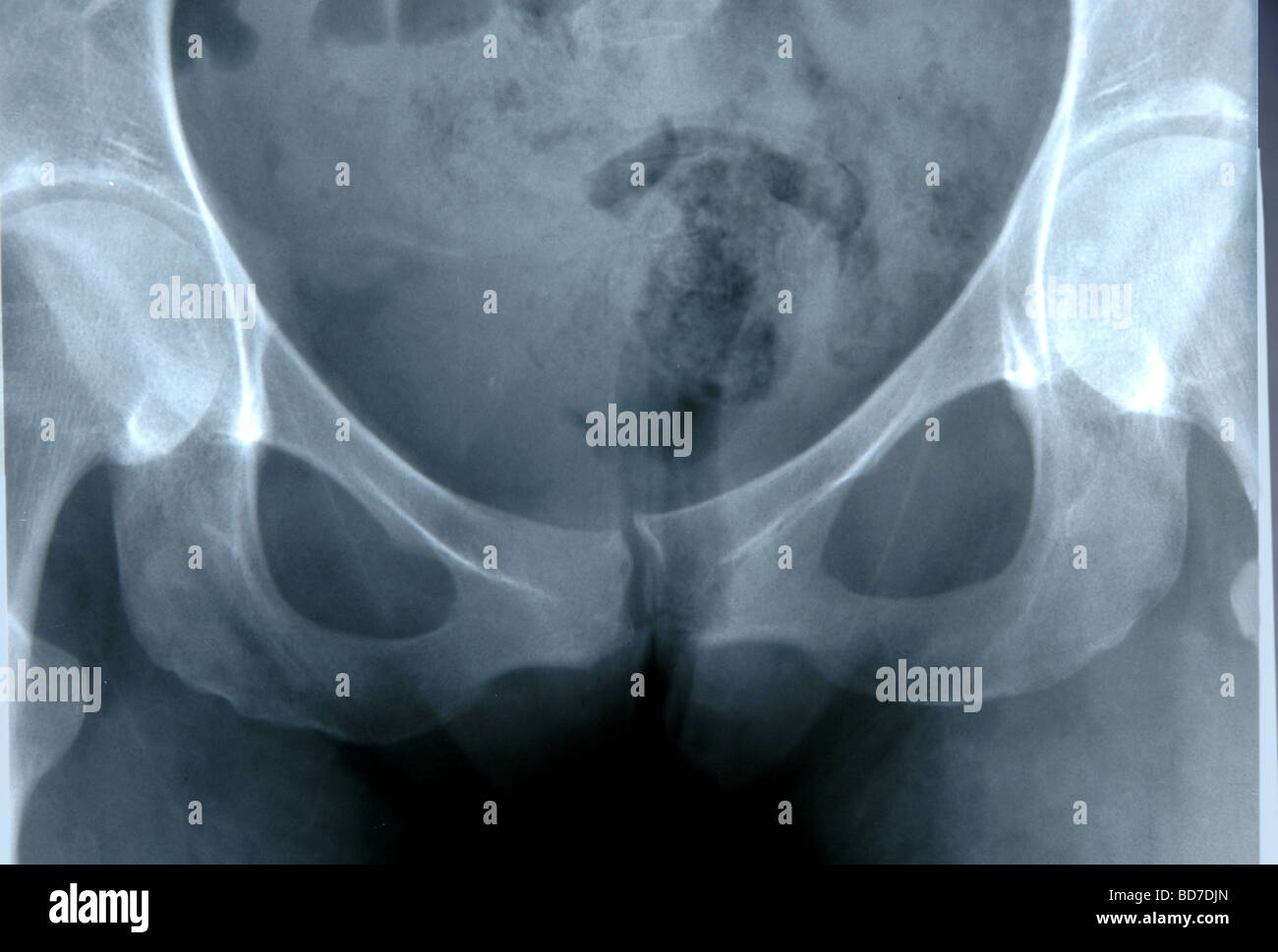 X Ray della pelvi umana mostra hip le ossa e la zona addominale Foto Stock