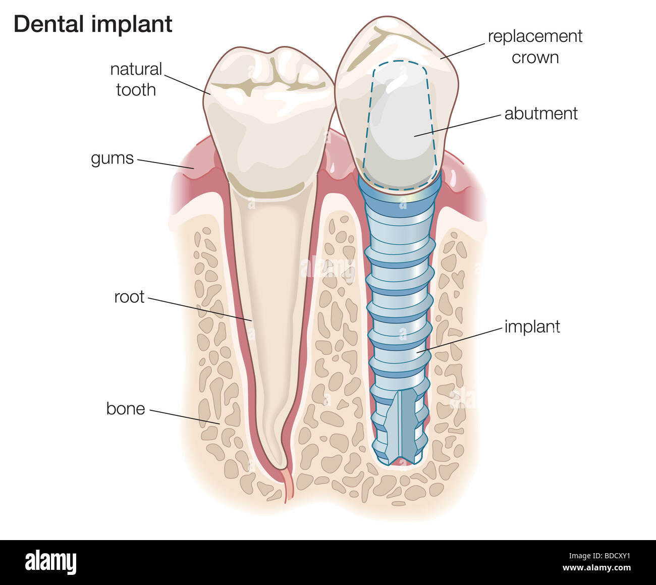 Impianto dentale Foto Stock