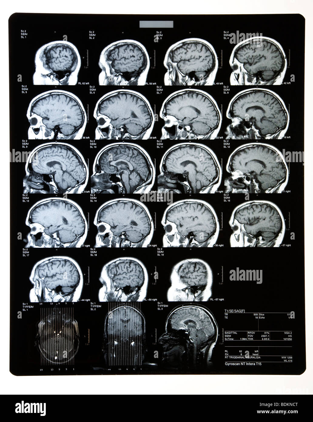 Scansioni MRI o lastre di testa che mostra il cervello e il cranio. Foto Stock