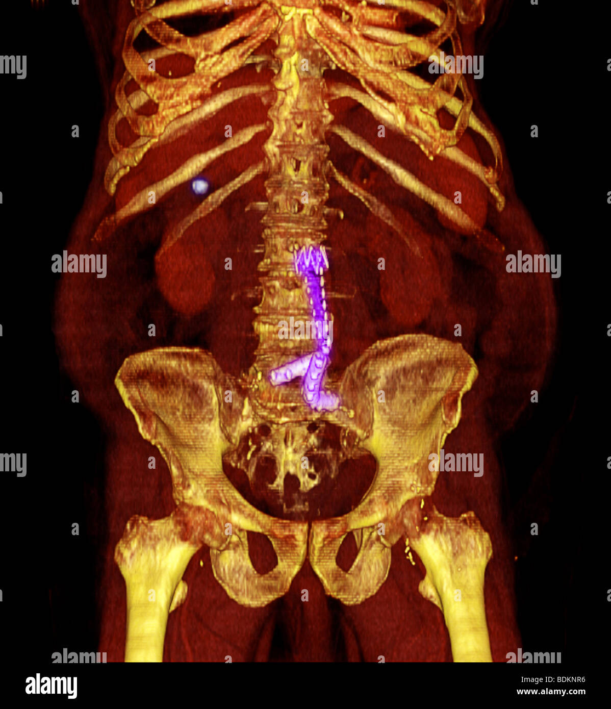 Colore esaltato tridimensionale di CT scan image di 80 anno vecchio uomo obesi. Foto Stock