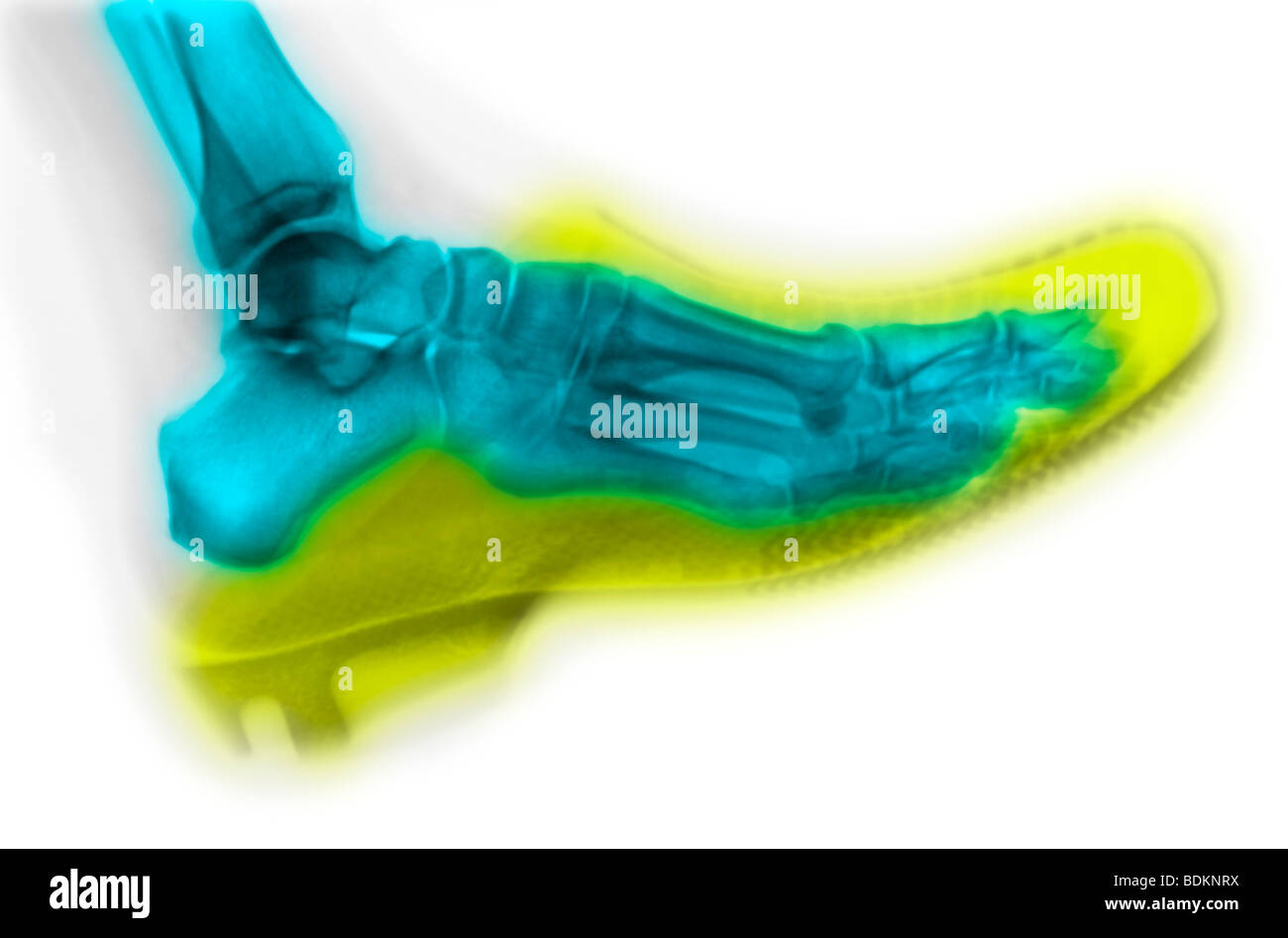 X-ray del piede di una persona che indossa un intasare Foto Stock