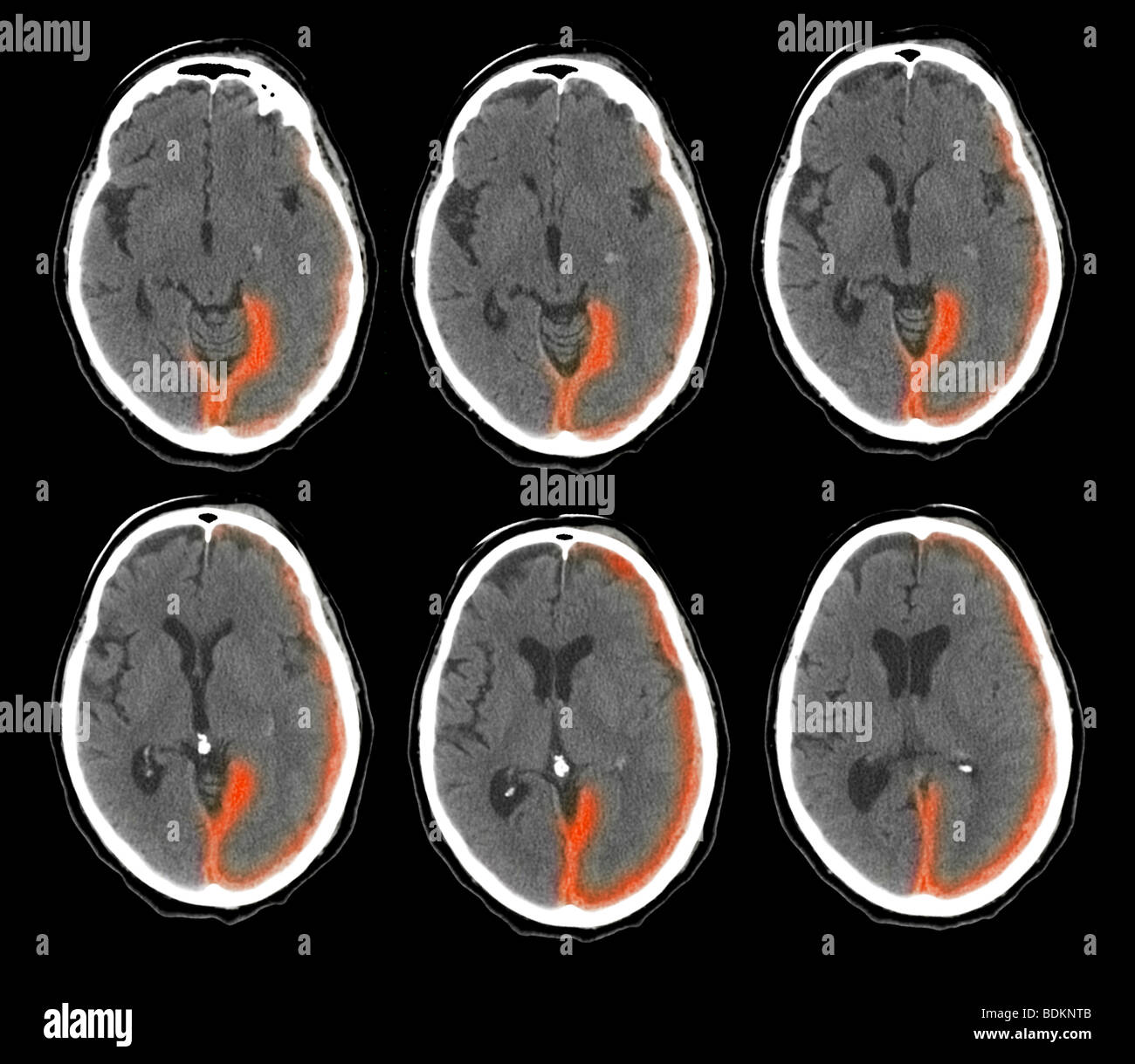 Scansione TC del cervello di un 73 anno vecchio mostrano emorragia intracranica Foto Stock