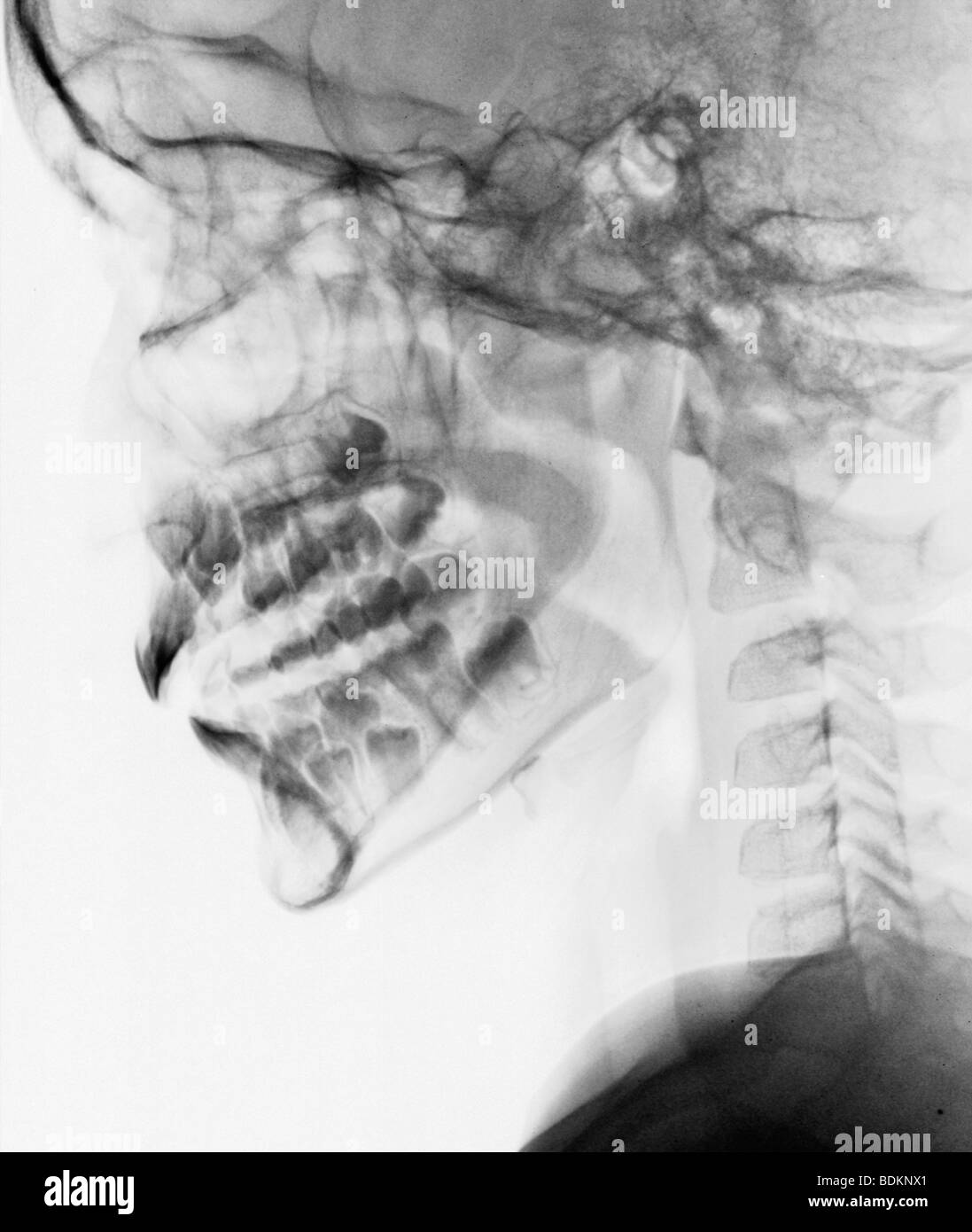 Cranio di raggi x di un 9 anno vecchio ragazzo, normale Foto Stock