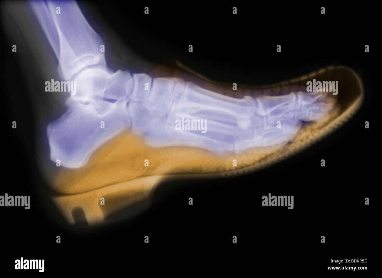 X-ray del piede di una persona che indossa un intasare Foto Stock
