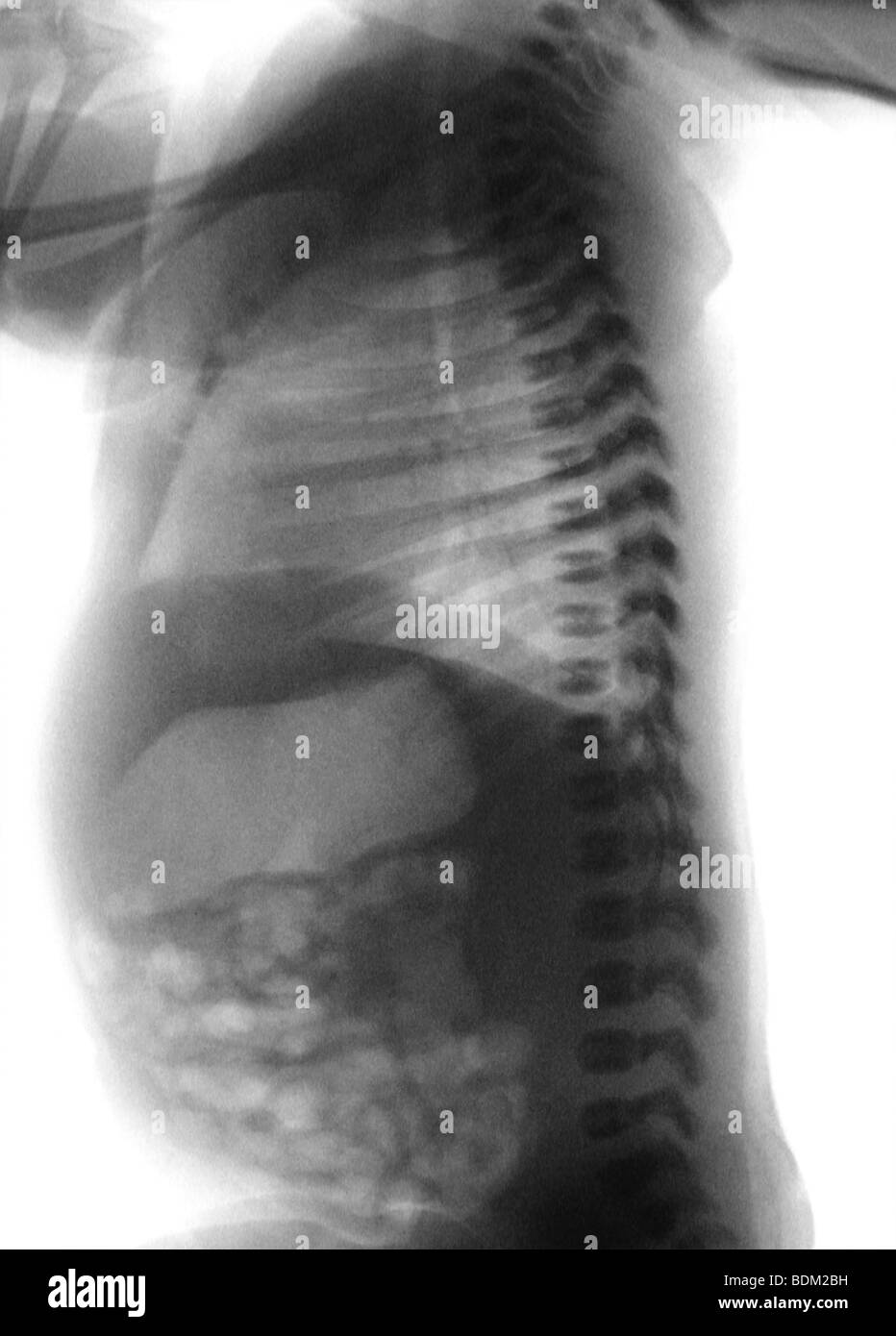 Il normale x-ray di 9 giorno di età infantile femmina Foto Stock