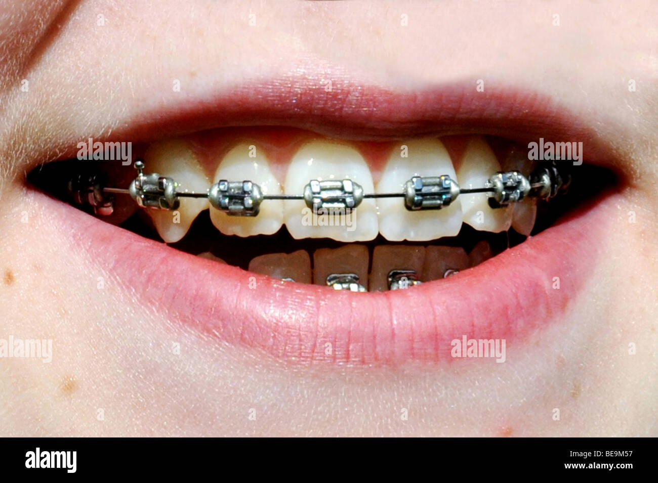 Apparecchio dentale Foto Stock