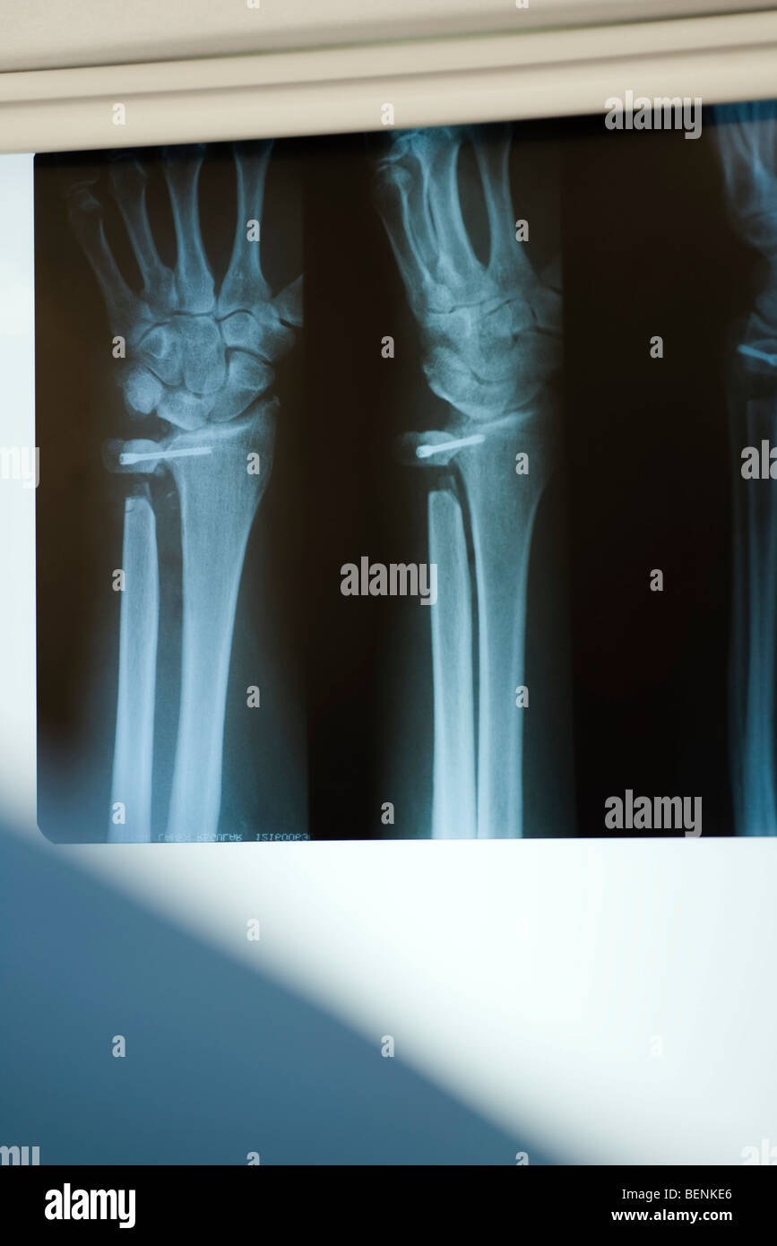 X-ray visualizzazione feriti radio e ulna Foto Stock