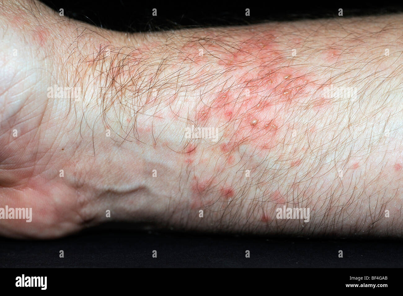 Orticaria orticaria immagini e fotografie stock ad alta risoluzione - Alamy