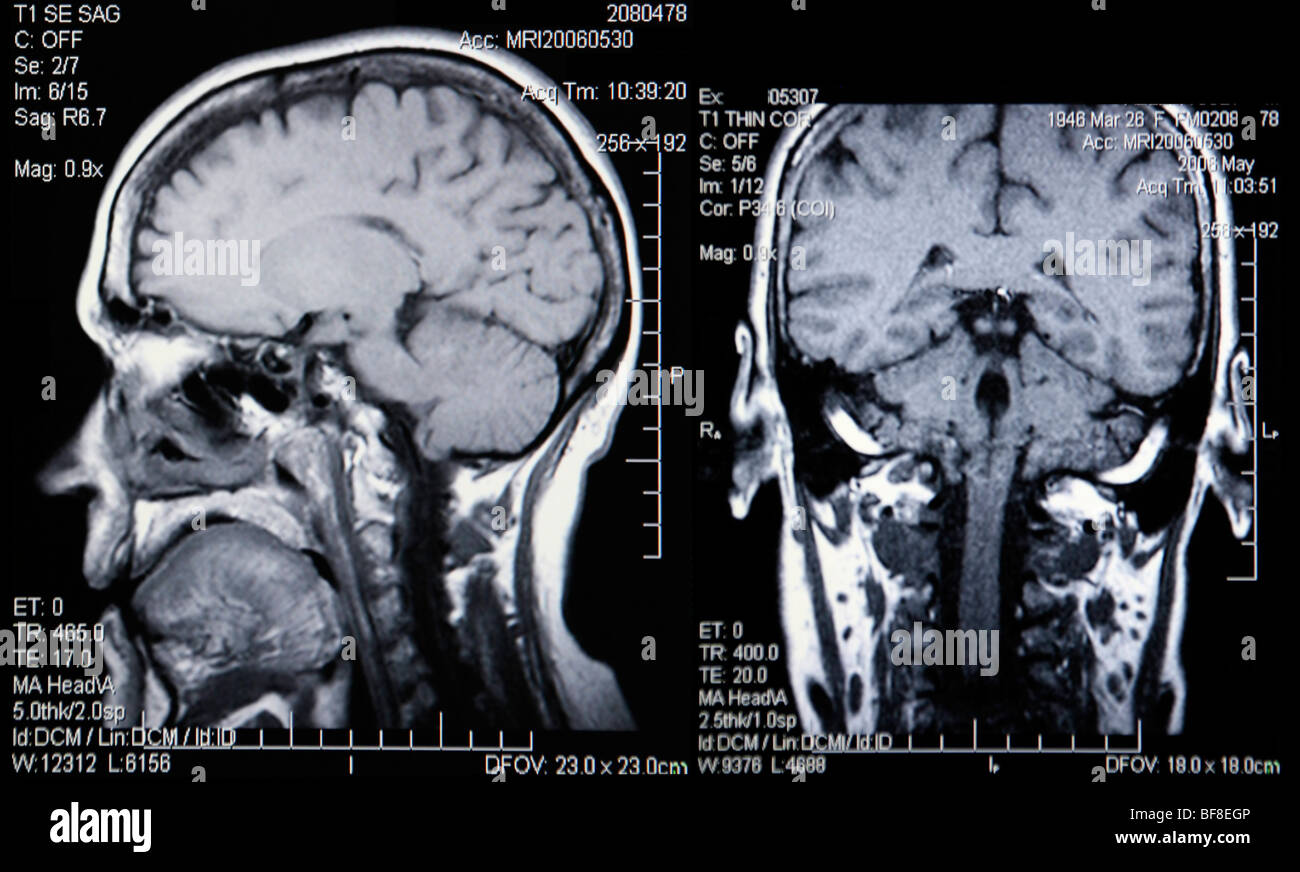 Doppia Vista del reale scansioni MRI della testa e del cervello Foto Stock