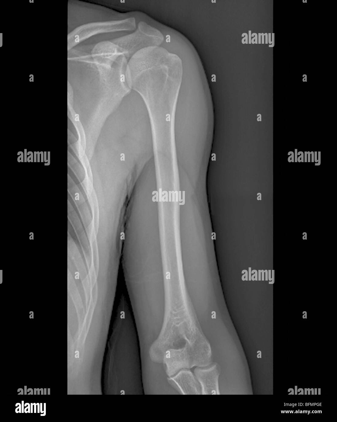 Spalla normale e giunti a gomito, X-ray Foto Stock