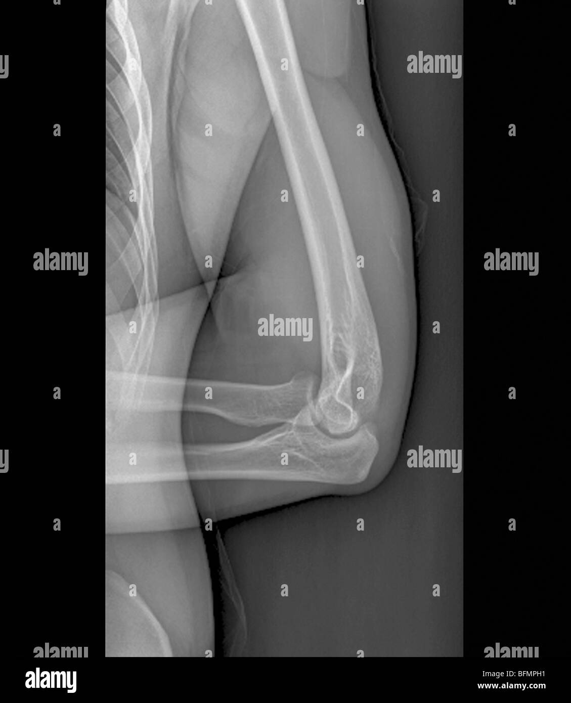 Normale giunto a gomito, X-ray Foto Stock