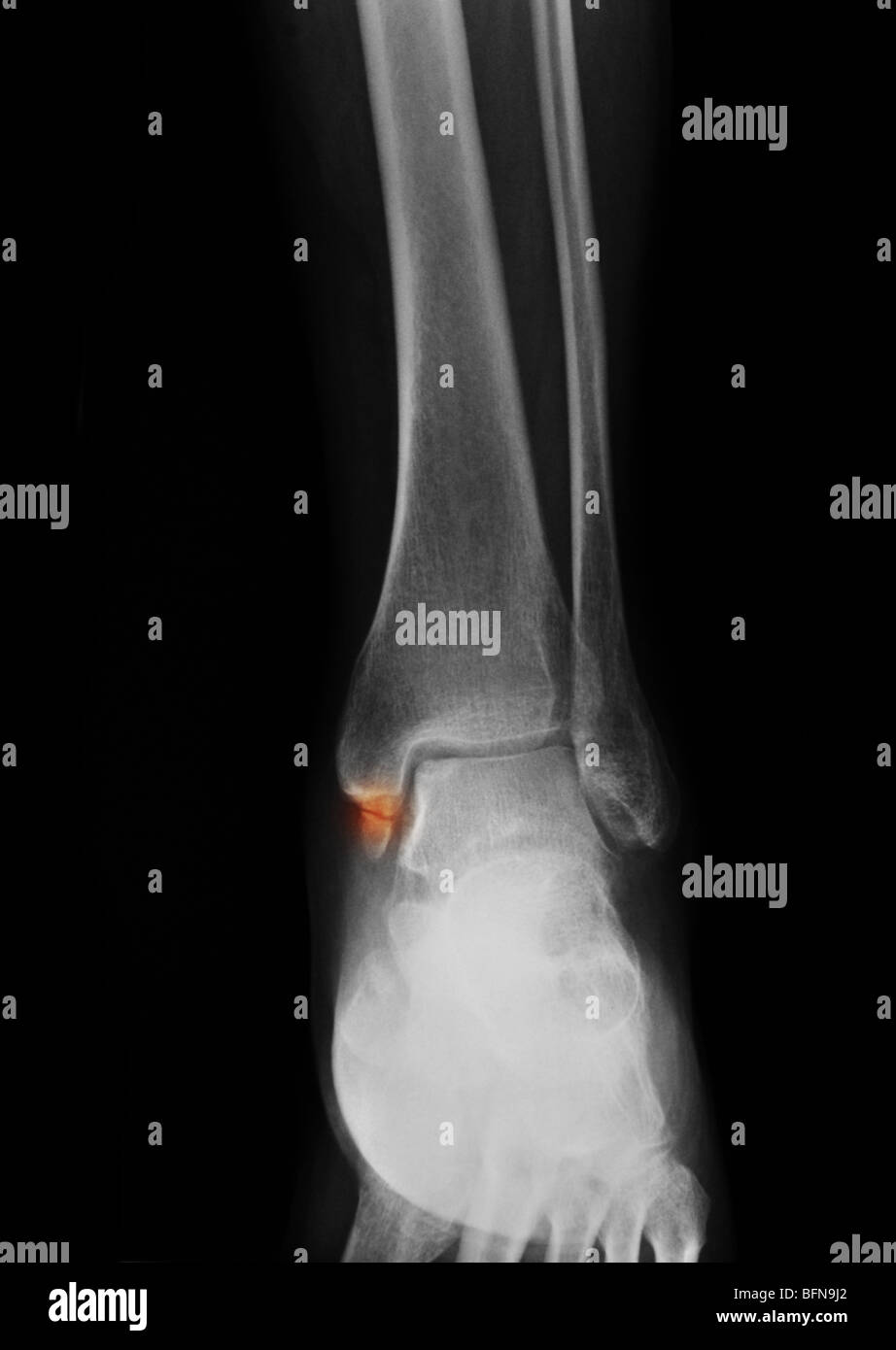Raggi X che mostra una caviglia frattura di un 38 anno vecchia donna Foto Stock
