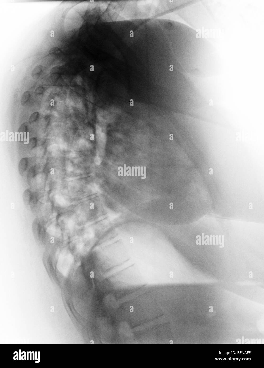 Torace anormale raggi x che mostra la polmonite in un 27 enne femmina con l'influenza. Foto Stock