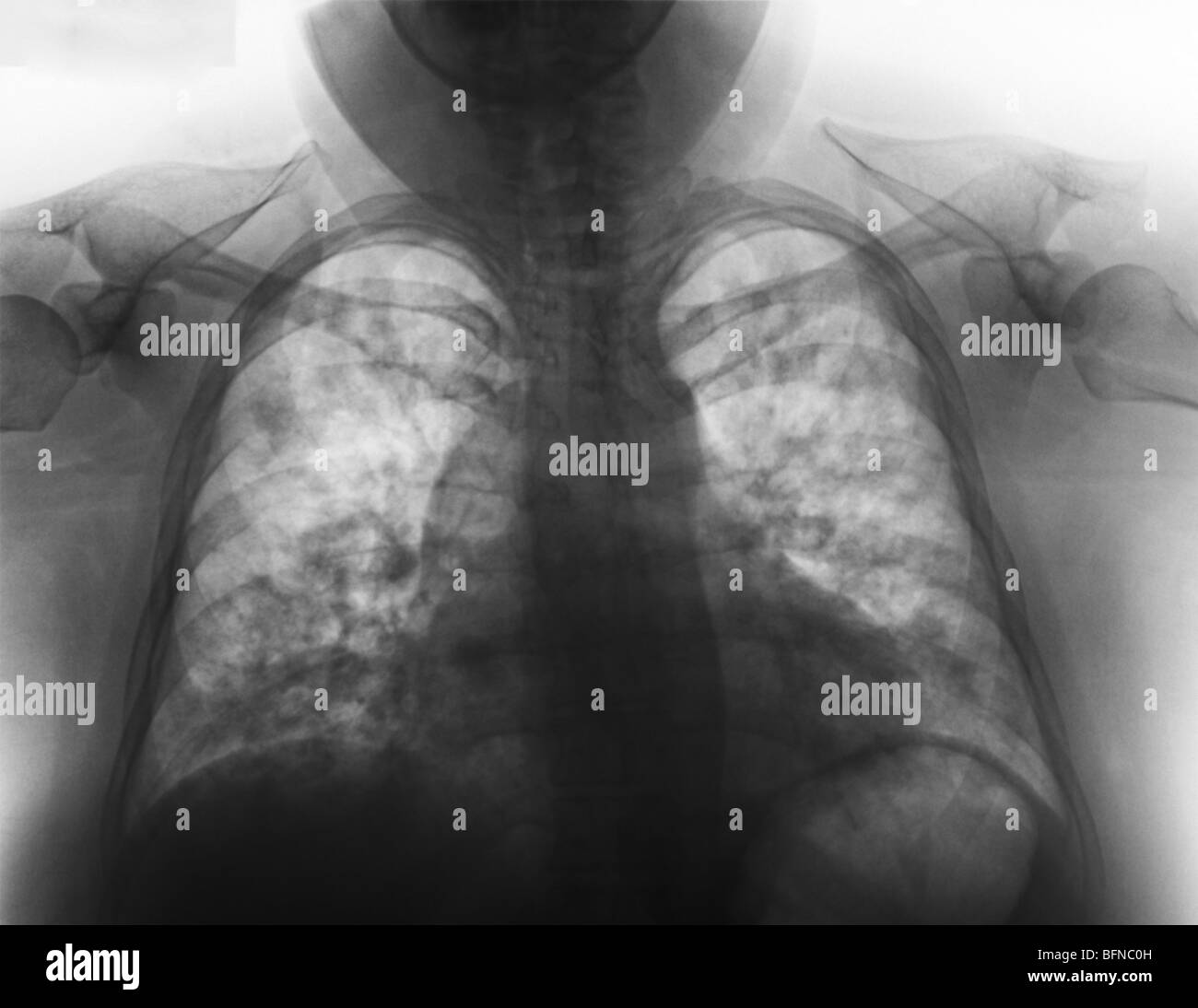 Torace anormale raggi x che mostra la polmonite in un 27 enne femmina con l'influenza. Foto Stock
