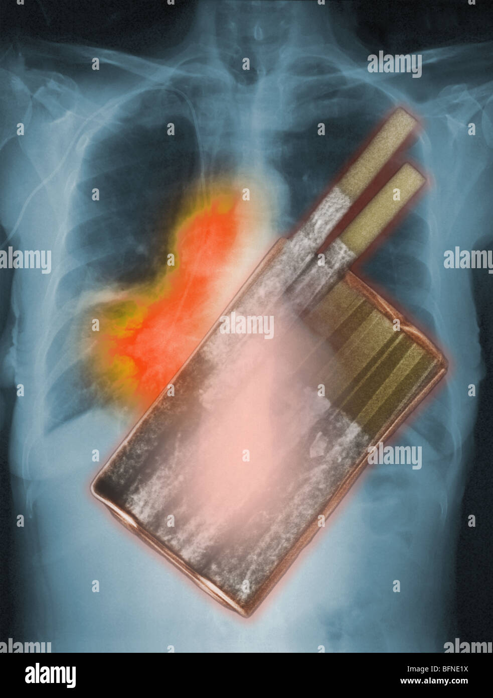 Sigarette, la principale causa di cancro ai polmoni, sovrapposto ad una radiografia del torace che mostra il cancro ai polmoni Foto Stock