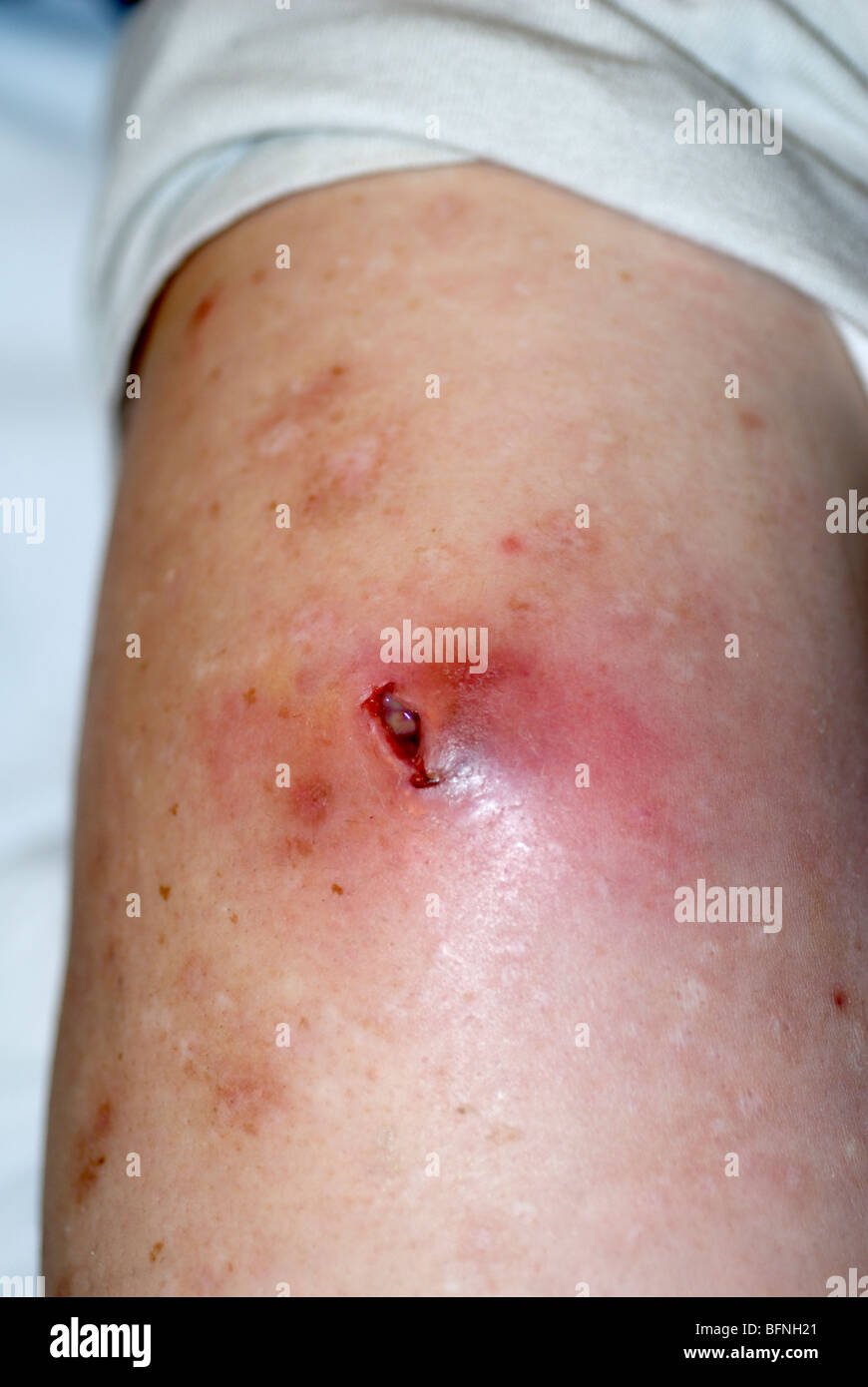 Resistente alla meticillina staph aureus infezione della pelle Foto stock -  Alamy
