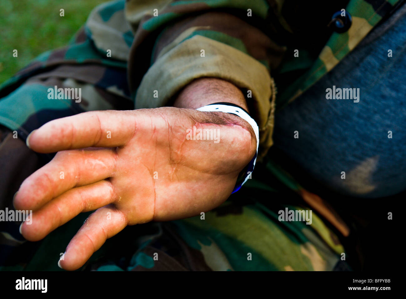 Un colombiano soldato paramilitari (AUC) mostra un pregiudizio proveniente da scontri con la guerriglia (FARC) in meta, Colombia. Foto Stock