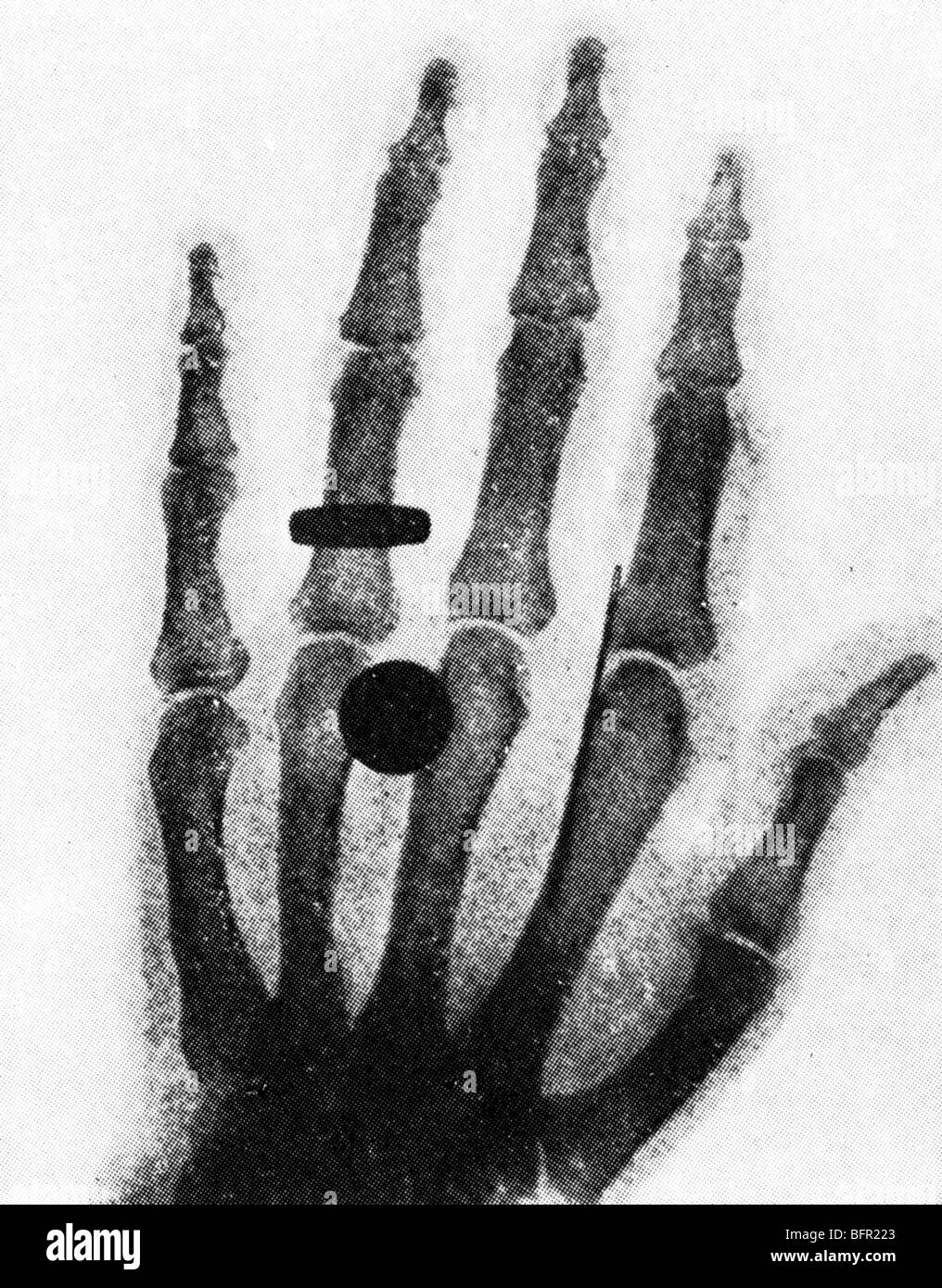 WILHELM Konrad von RONTGEN scoprì i raggi X nel 1895. Una delle sue prime immagini. Foto Stock
