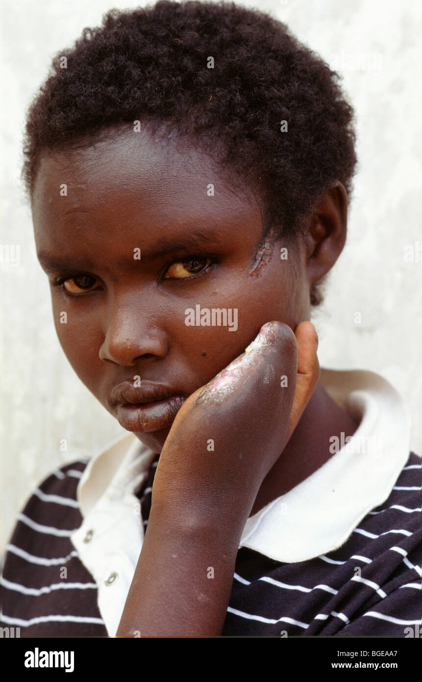 Kyonza, Ruanda, agosto 1994; Joanne d'Arc Mkannana, 15, a Kyonza orfanotrofio, aveva le sue dita tagliate da mititias Hutu. Foto Stock