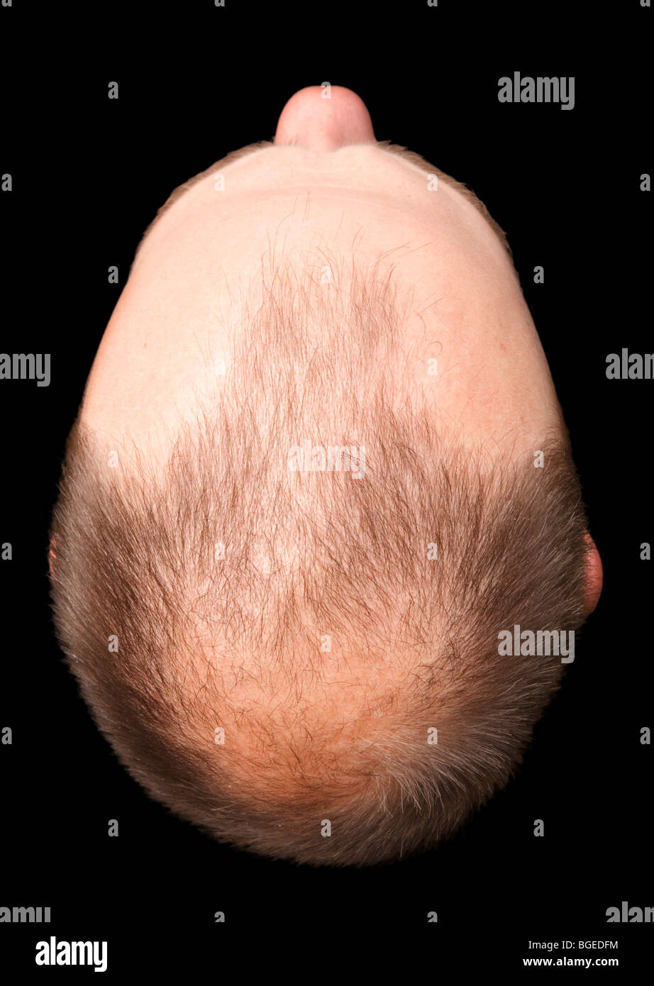 Una testa di balding visto dal di sopra, isolata contro uno sfondo nero Foto Stock