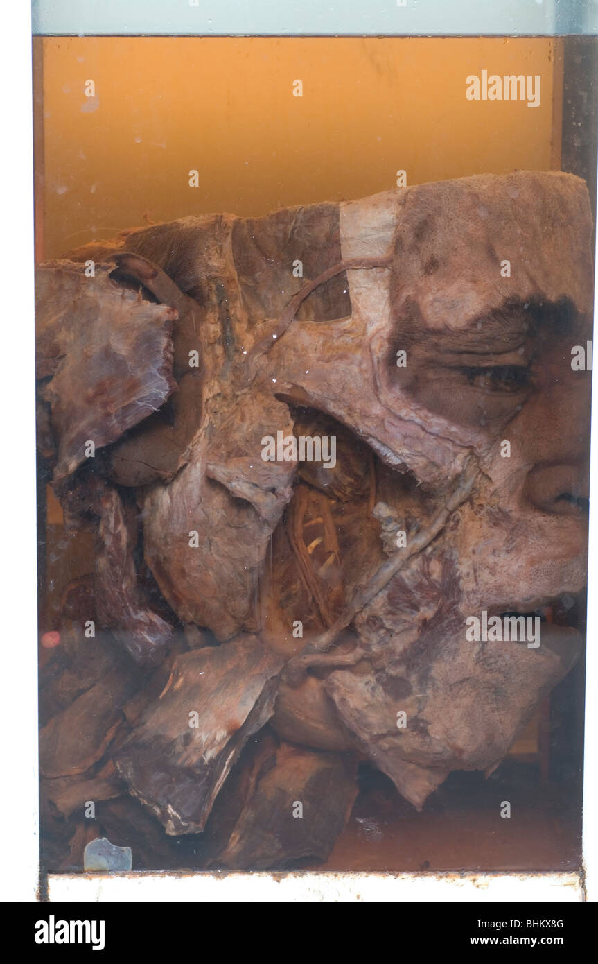 Close up di un uomo morto conservati di testa in un vasetto di vetro Foto Stock