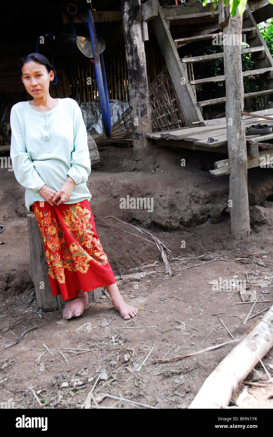 Un Karen le donne che soffrono di Elephantiasis con gamba gonfia , campo per rifugiati di Mae La, , della Thailandia Foto Stock