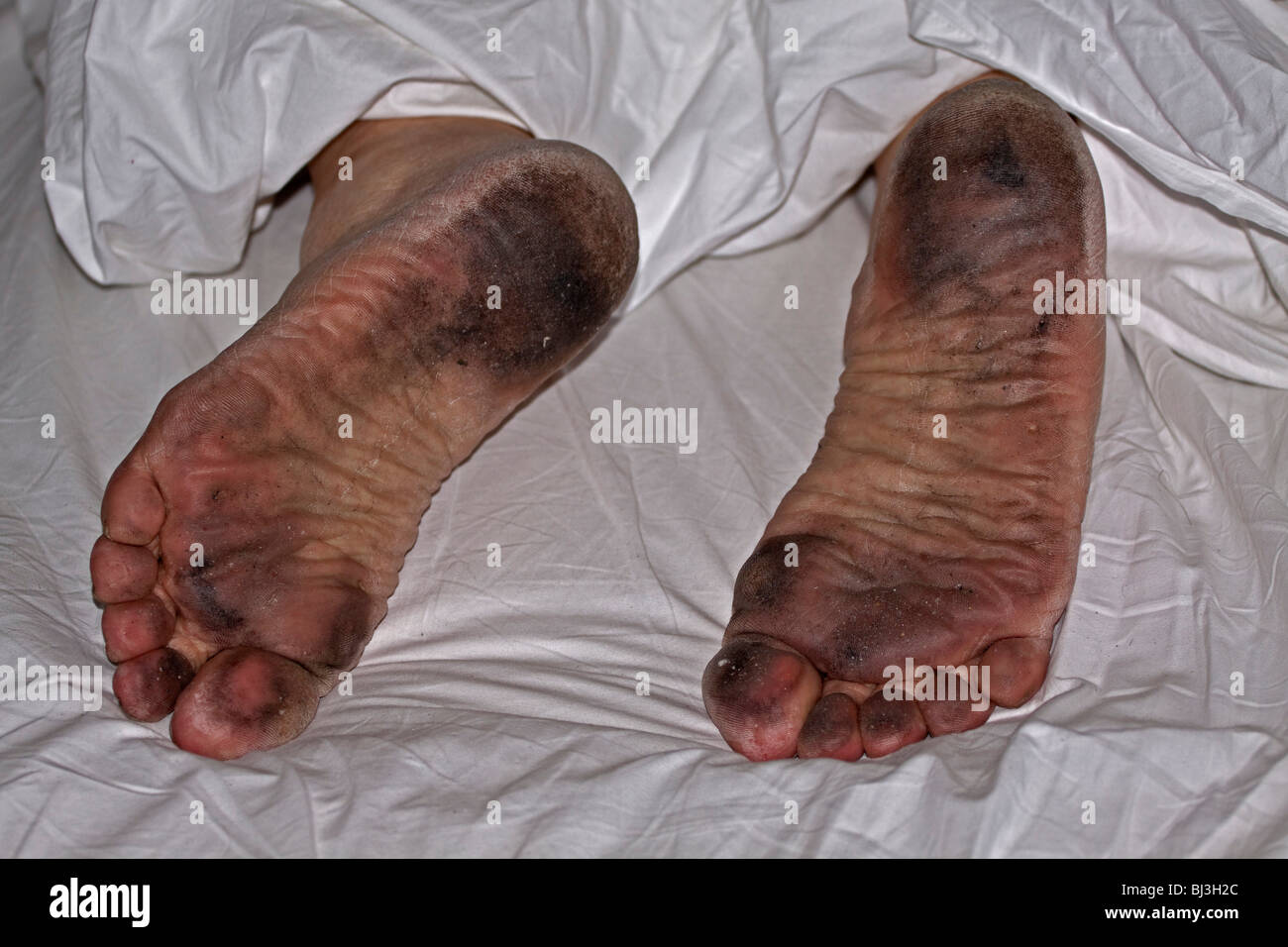 Mal curato piedi sporchi in fogli bianchi, igiene personale Foto Stock