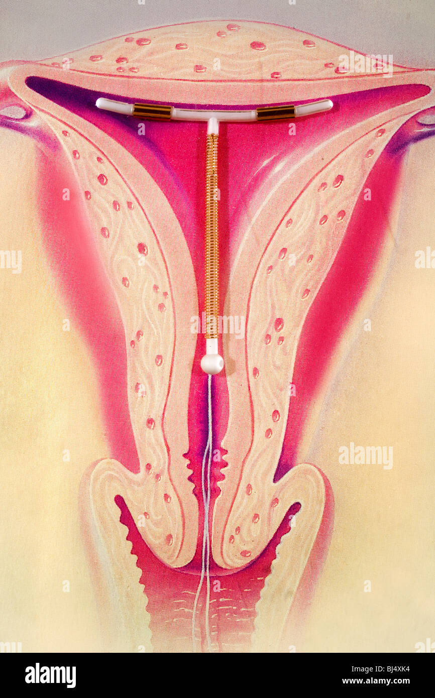 Il ParaGard T-380A (mostrato contro un utero illustrazione) è un contenenti rame dispositivo intrauterino avvolta con filo di rame. Foto Stock