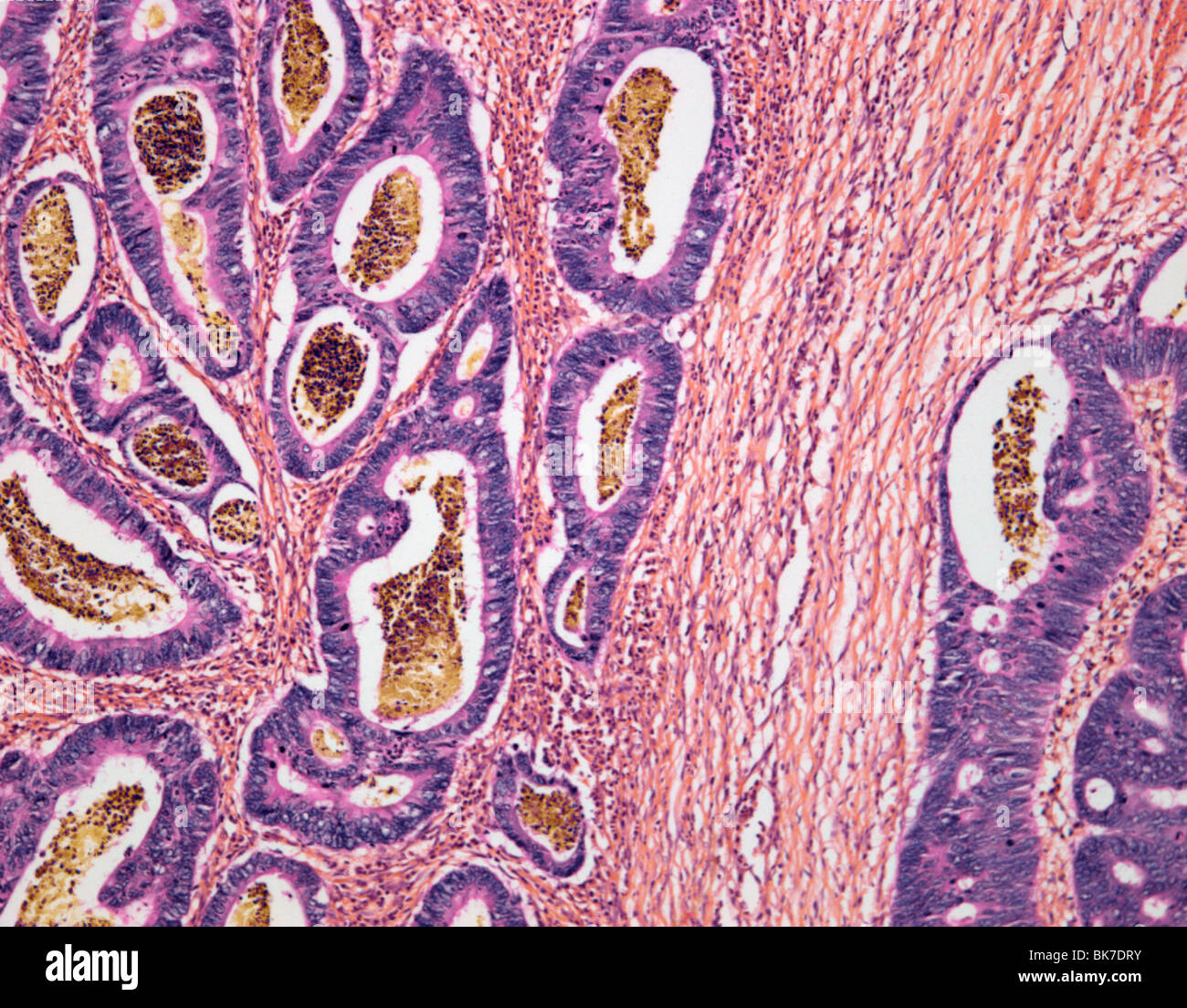 Il cancro del colon, micrografia di luce Foto Stock