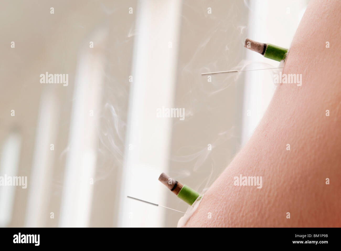 Aghi di agopuntura e sigari di erbe su una persona del braccio Foto Stock