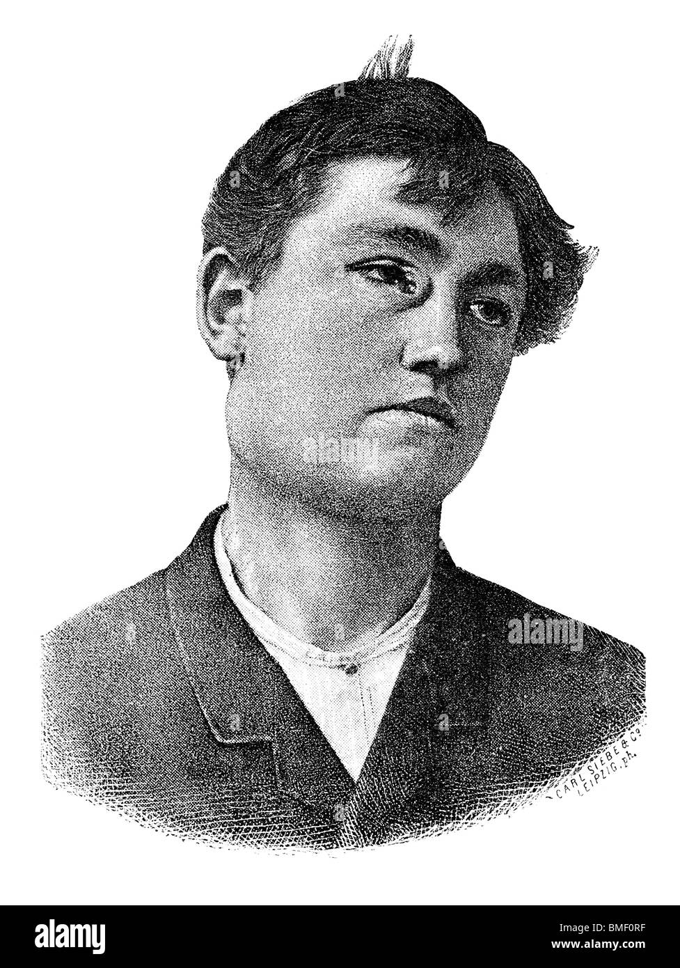 La sifilide nell'occhio. Vecchia Illustrazione medica da Lehrbuch der Haut- und Geslechtskrankheiten von Dr. Edmund Lesser 1887. Foto Stock