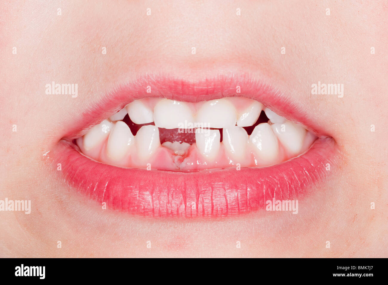 Un modello rilasciato ragazzo di 6 mostra il suo primo latte dente divario come suo dente ha appena caduto nel Regno Unito Foto Stock